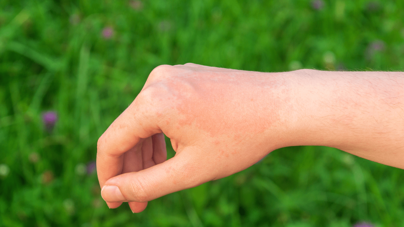 Die Sonne und Neurodermits – Wir bringen Licht ins Dunkel